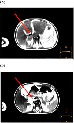 Successful sequential management of traumatic choledochal leak and stenosis in children using ERCP: a case report and literature review